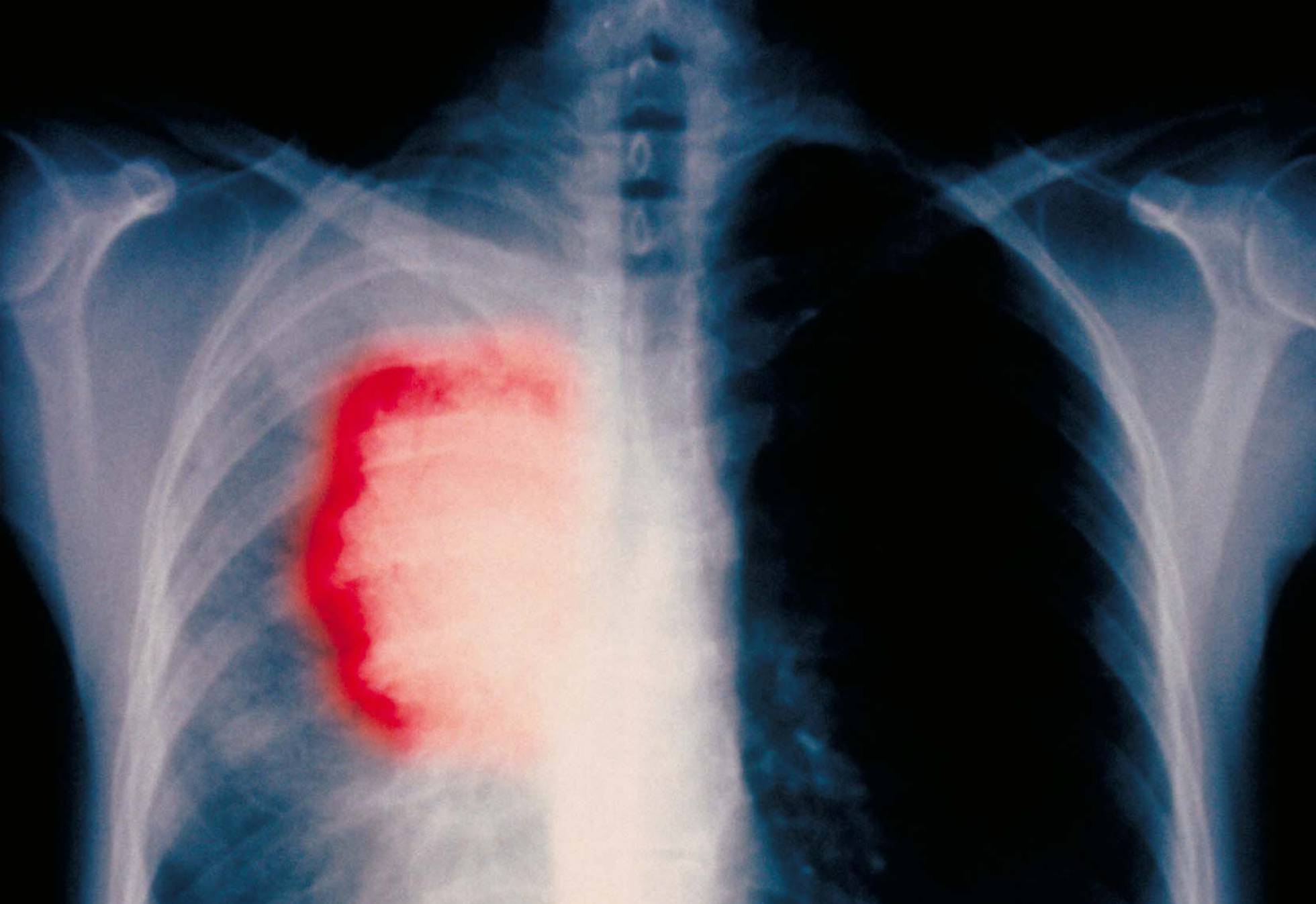 Radiografia d'un pacient fumador de 58 anys amb càncer de pulmó AGE FOTOSTOCK