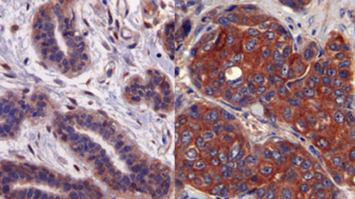 Teixit-mama-tumoral-proteina-LIPG_1553254804_28223758_651x366