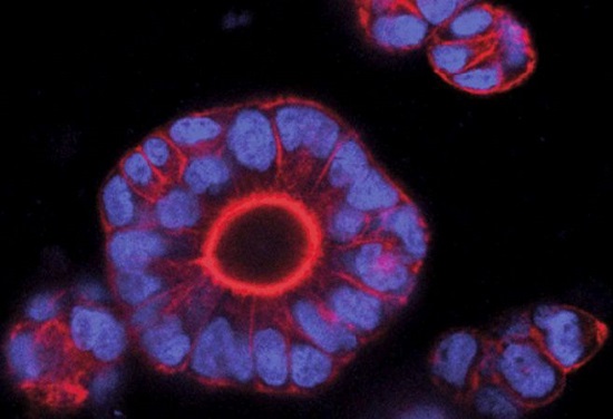 pronòstic tumors càncer de còlon