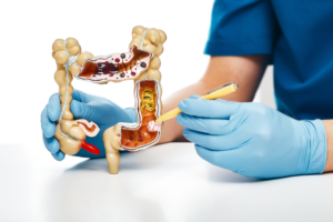 Médico enseña cáncer colorrectal
