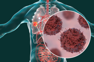 Diálogo FECEC sobre el cáncer de pulmón