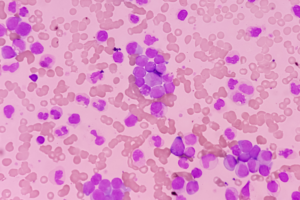 junts-contra-el-cancer-leucemia-mieloide-cronica