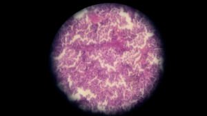 dia-internacional-càncer-neuroendocrí