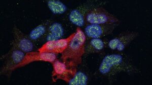 metàstasi-del-càncer-de-mama